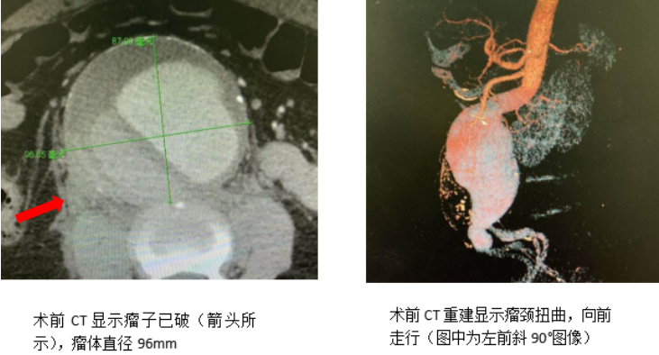 后腰下腹突发剧烈疼痛竟是致命的腹主动脉瘤清华长庚血管外科紧急拆弹