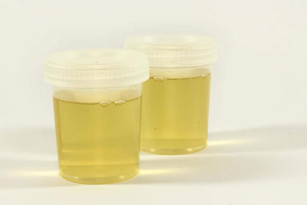 尿完别马上冲,观察一下!通过11种尿液颜色,气味,性状看健康