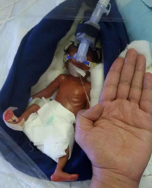 当初,那位打破吉尼斯世界纪录的"拇指宝宝",如今现状如何?