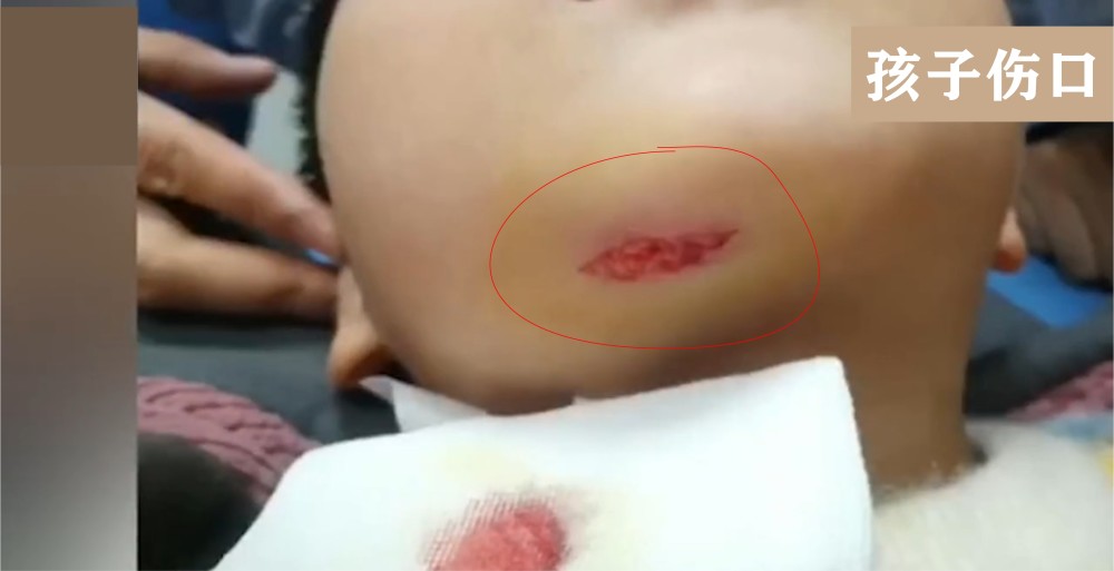 男童被幼师提摔下巴破裂缝8针
