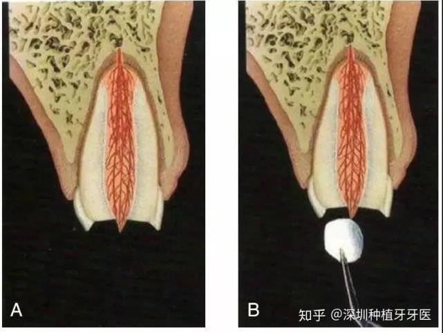 什么是活髓切断术 步骤解析 腾讯网