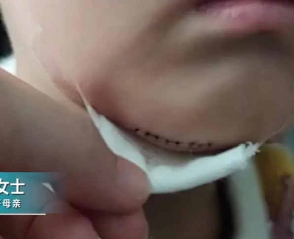 愤怒男童被老师提起后摔在地上下巴缝8针官方回应来了