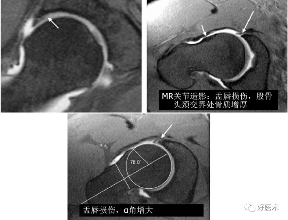 鉗夾撞擊型fai—髖臼加深,髖臼盂唇撕裂五,綜述臨床表現fai多見於中