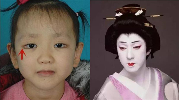 娃太漂亮也是病4岁女孩拥有天使面孔父母却为此一筹莫展
