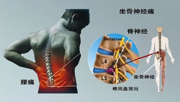 主要表現為腰痛,坐骨神經痛,由於神經的壓迫,常見症狀還伴有腰疼,腿疼