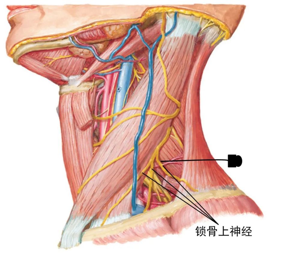 锁骨上神经卡压针刀治疗