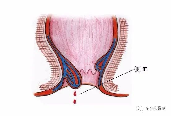 痔疮外痔肉球怎么消除用什么药?做好这几点轻松自愈!收藏!_腾讯新闻