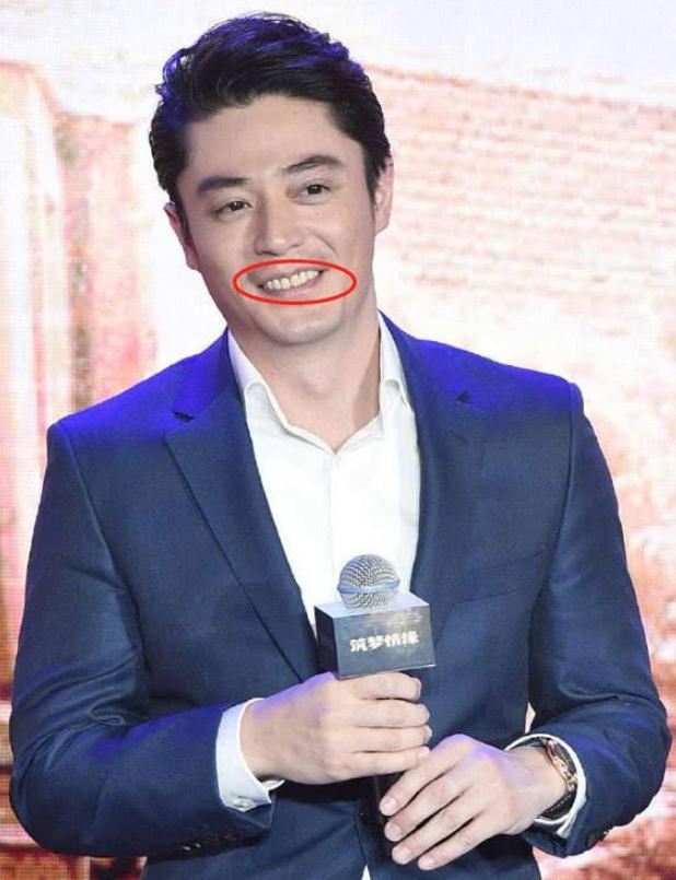 明星真牙,假牙分不清?烤瓷牙翻车不在少数,一口大白牙合不上嘴!