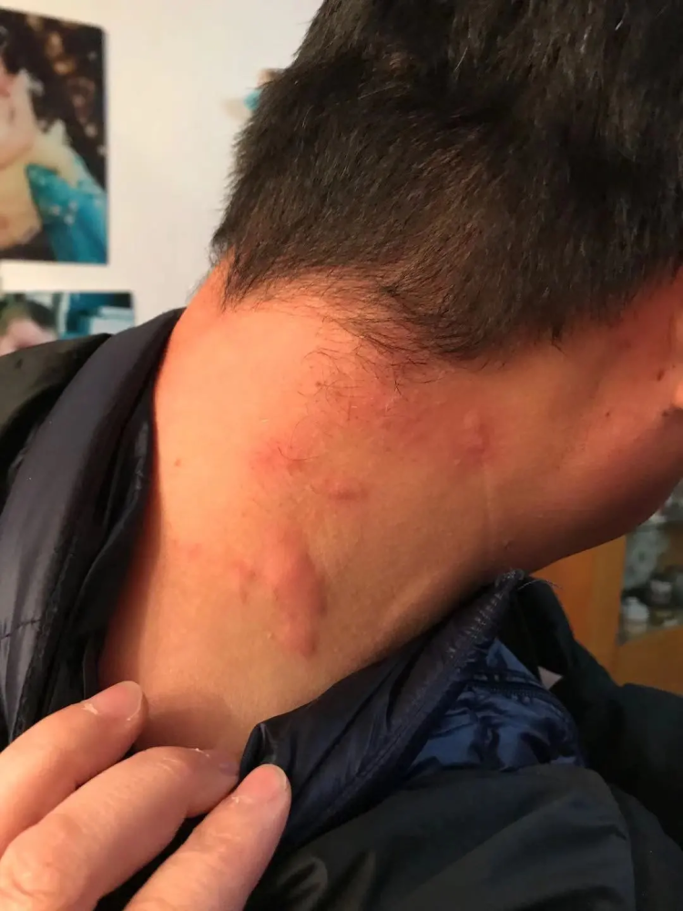 于是同事为他拍下了一张都是"风团"的照片:然而脖子的瘙痒并没缓解