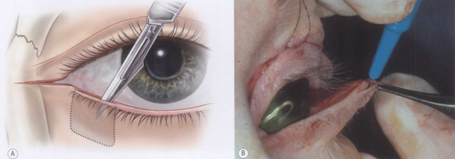【眼瞼形成術】瞼板條眥成形術!