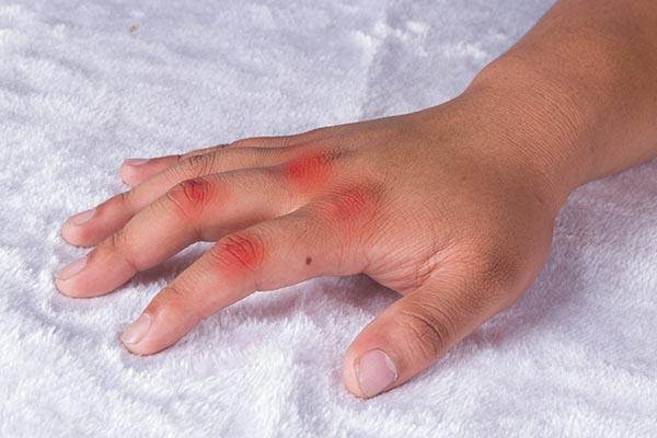 痛风又被叫做 帝王病 它到底有多痛 如何缓解疼痛 腾讯新闻