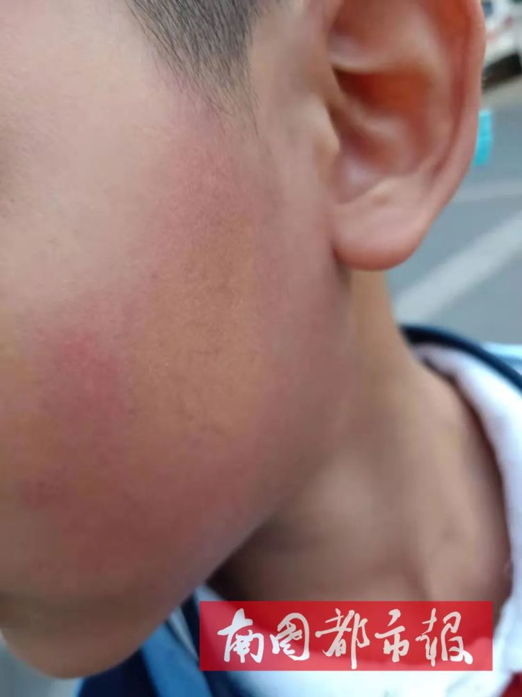 红肿淤青海南一午托中心宿管打肿10岁男孩脸只因