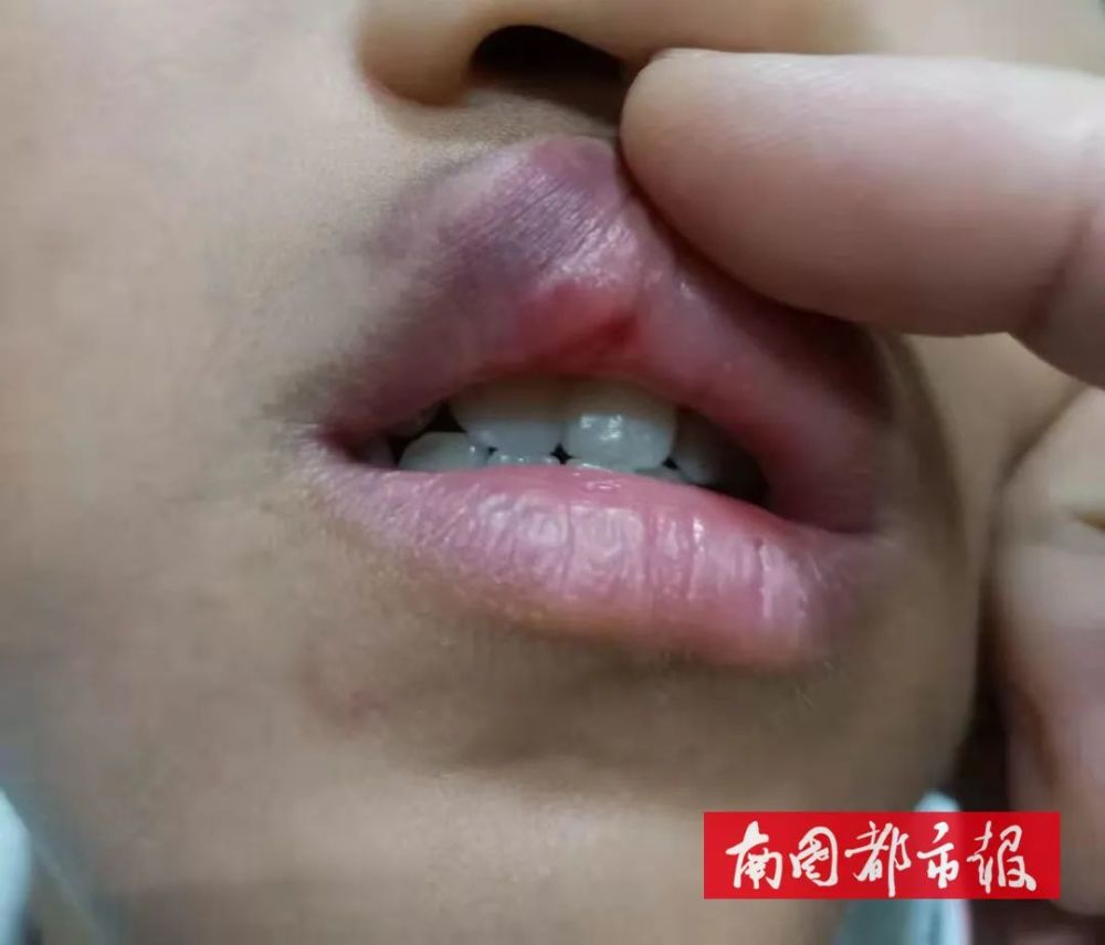 红肿淤青海南一午托中心宿管打肿10岁男孩脸只因