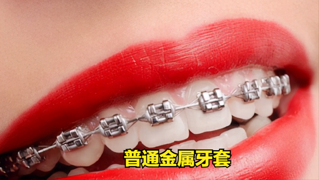 不同大致分五种:普通金属矫正,自锁矫正器,舌侧矫正,陶瓷牙套(半隐形)