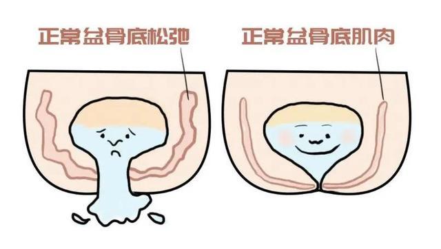 产后患上社交癌,盆底肌松弛漏尿怎么破?