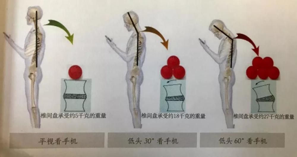 低頭玩手機頸椎壓力相當於承重50斤以上