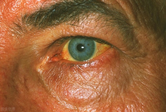 小便发黄皮肤发黄这几个表现是黄疸给你的信号这2个治疗方法要谨记