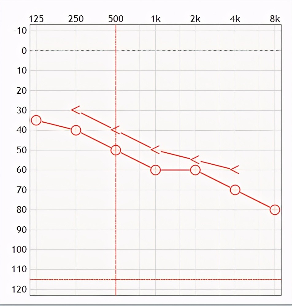感音神经性听力损失听力图:上方线为骨导测试后听力,下方线为气导测试