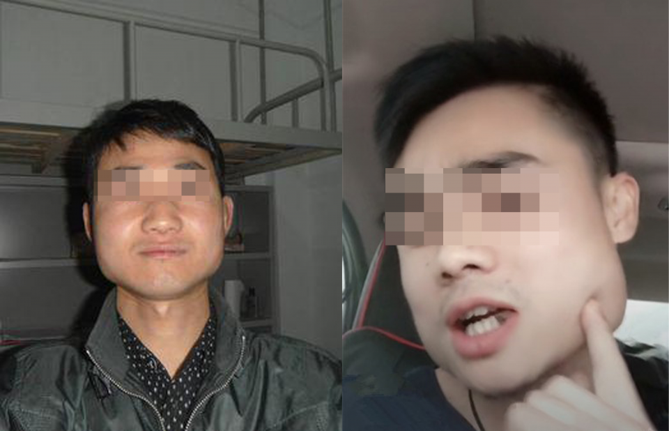 嚼槟榔让下颚变大变宽可以做下颌骨手术吗别让自己成负担了