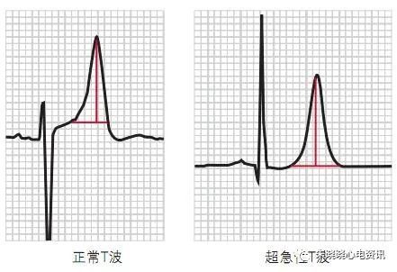 电压可高达2 mv(1)超急性期的t波高尖1