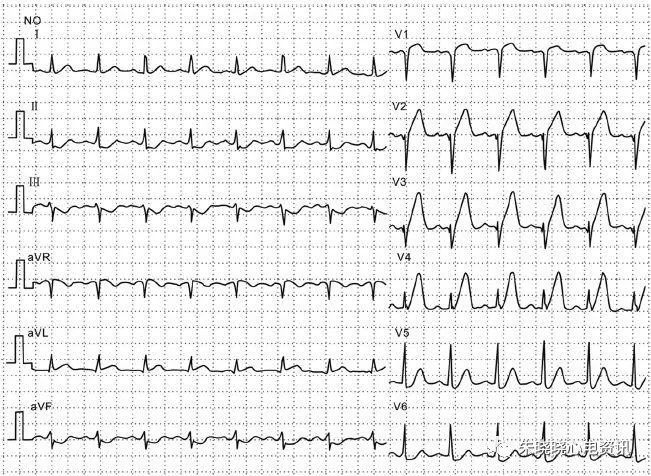 快速掌握急性心梗的心电图判读