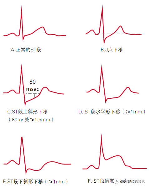 st段抬高持续数天后逐渐下降,提示心肌微循环未再灌注,常见于罪犯血管