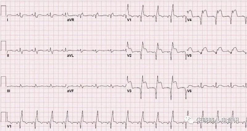 10分鐘快速掌握急性心梗的心電圖判讀