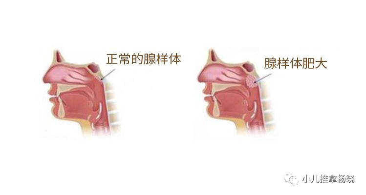 济南小儿推拿杨晓：腺样体肥大是怎么回事？中西医一般如何治疗？_腾讯新闻