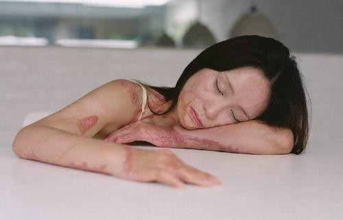 16岁女孩因婉拒官二代追求,被泼硫酸毁容,9年过去,她已大变样