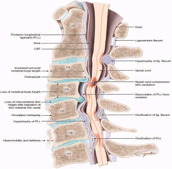 而如果由于颈椎间盘突出等等原因压迫到椎管里的脊髓的话,导致脊髓的