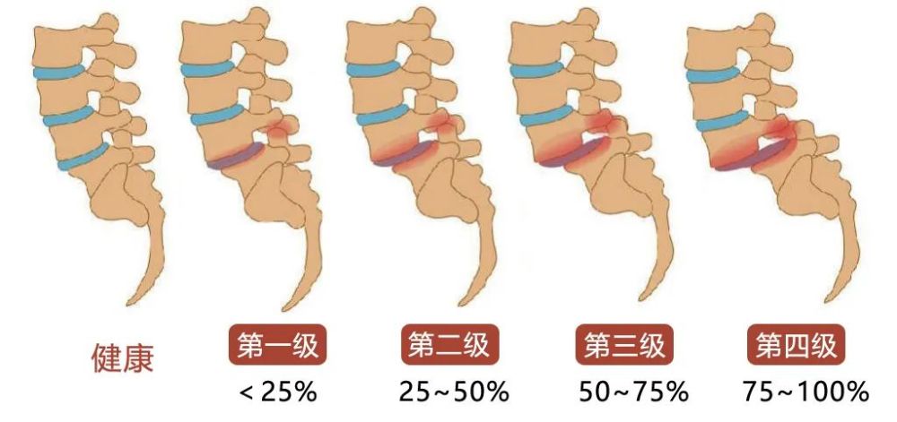 郴州骨科医院教授提醒下背痛当心腰椎滑脱压迫神经