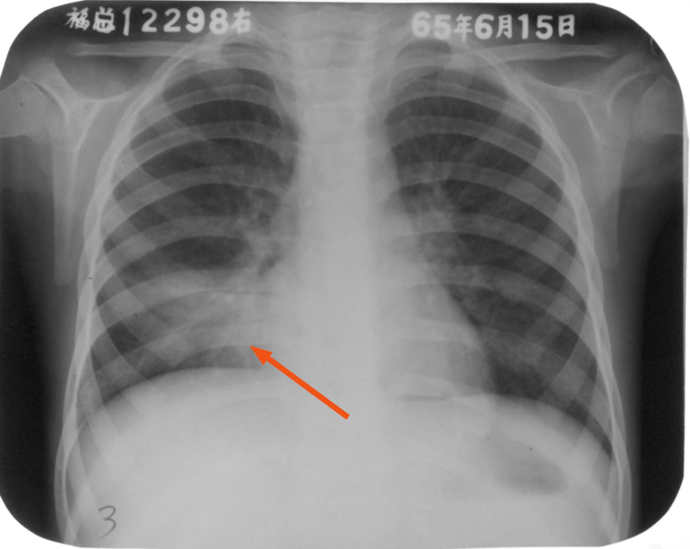 小叶性肺炎的x线表现图片
