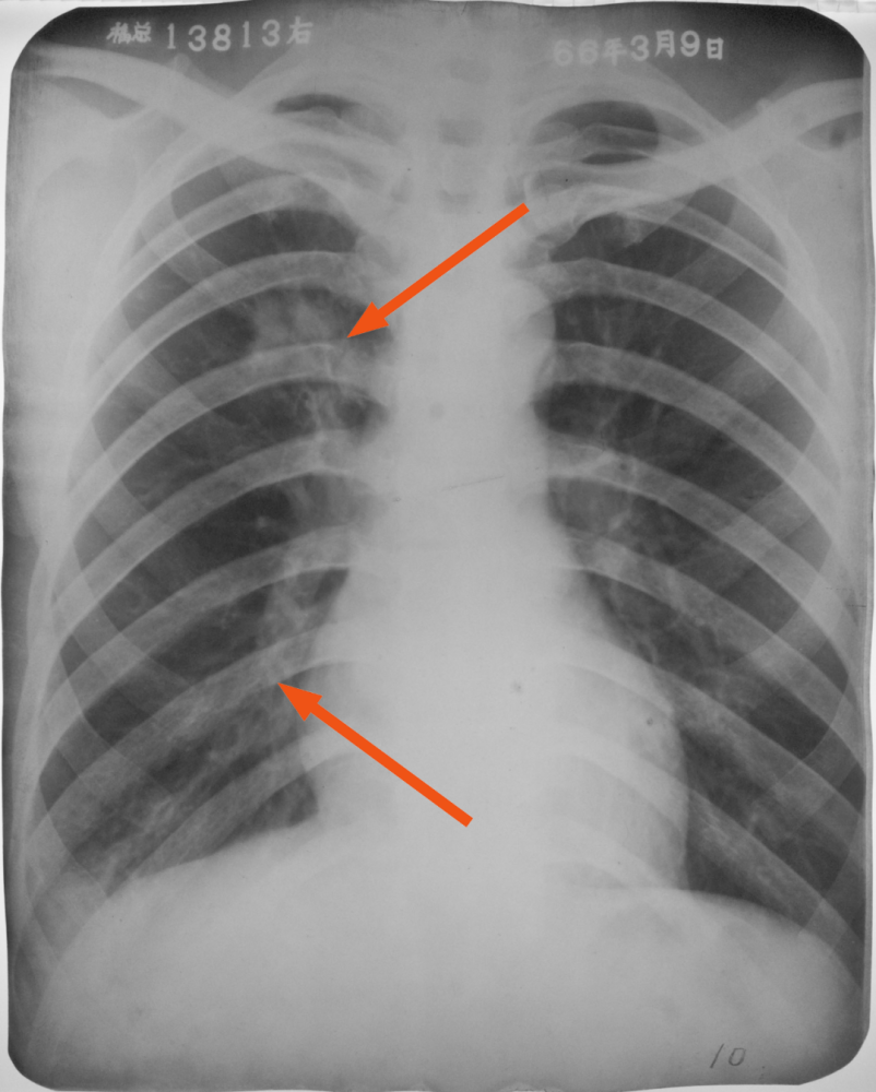 肺炎片子图片怎么看图片