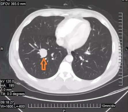 密度均匀,一般良性可能性大,如实性结节有如下特征:呈浅分叶状,周边有