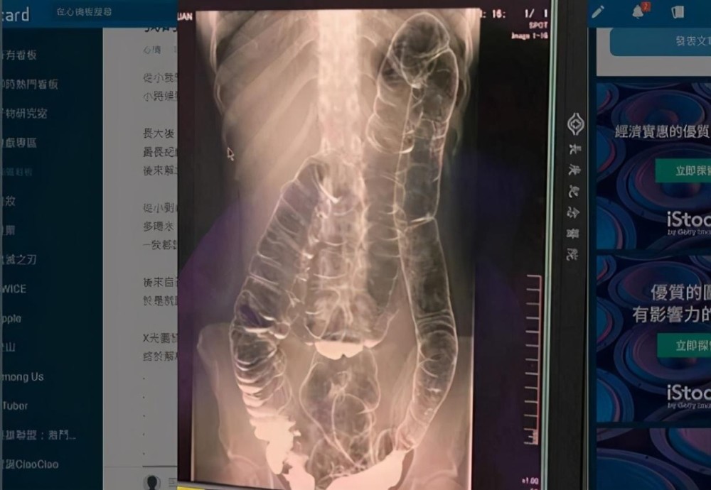 23岁女子最长17天没大便!x光片惊见大肠塞满屎,被挤到心脏了