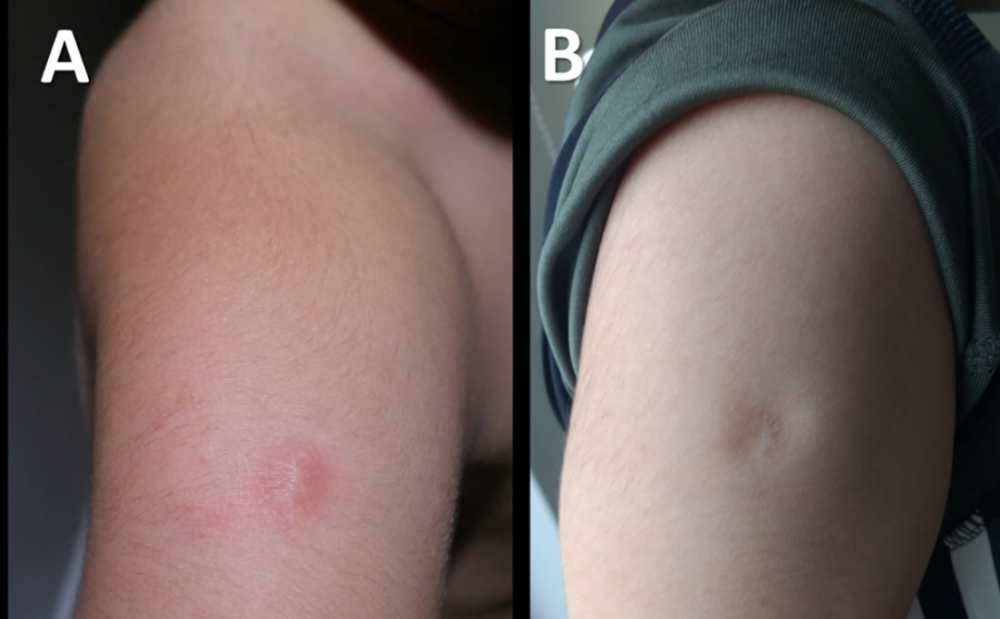 48小时后消退,b是该儿童正常卡疤表现这种表现可能和接种疫苗后,引起