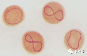 (12)卡波环:在嗜多色性,碱性点彩红细胞胞质中出现紫红色细线圈状结构