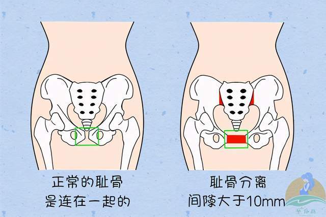 自然状态下,耻骨的间距仅为4~5mm,而怀孕后,在孕激素的影响下,准妈咪