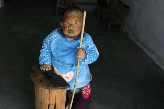 直击一位31岁的巨婴不会说话不会走路与母亲相依为命