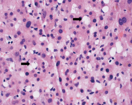 本病例肝脏病理 图源:参考资料 1星状细胞是肝脏中一类位于肝窦状隙