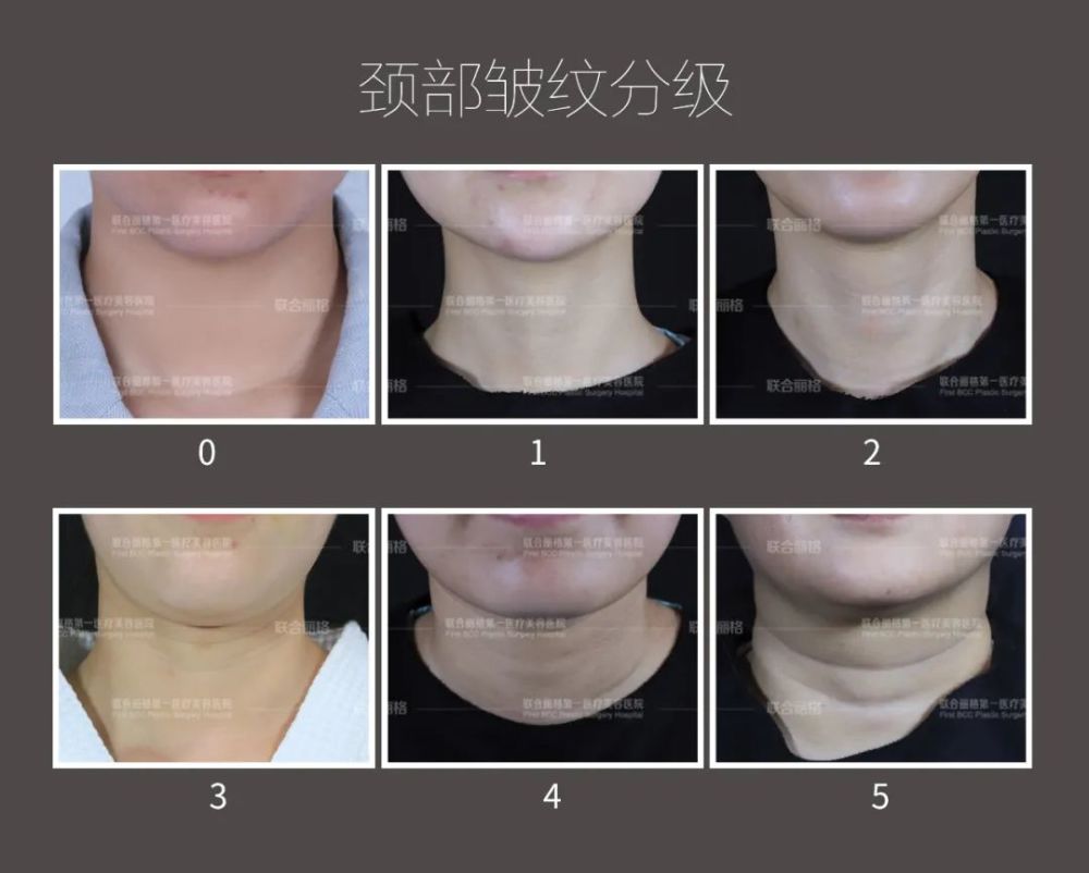 不同等级的颈纹,改善方法也是不同的,就要根据自己的实际情况来具体