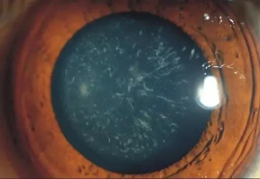 【科普】了解白内障(上)