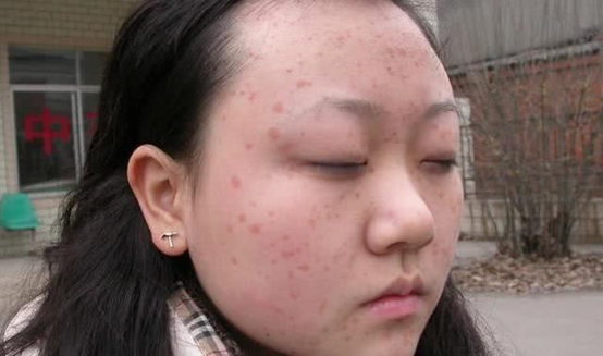 18岁大学生感染hpv,妇科主任:1事伤"宫"不浅,别不当回事