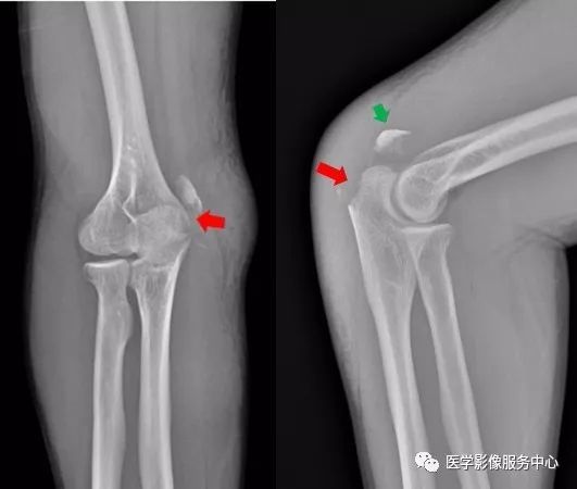 独立值班了这些骨折你都看出来了吗 附注解 腾讯新闻