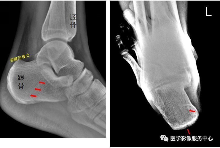 独立值班了这些骨折你都看出来了吗 附注解 腾讯新闻