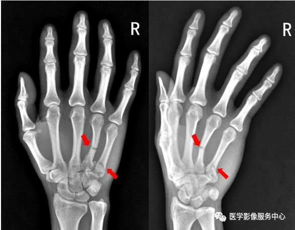 独立值班了这些骨折你都看出来了吗 附注解 腾讯新闻