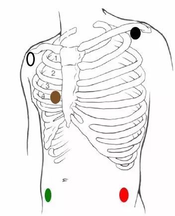 3 导联心电导线颜色标记为红,黄,绿或白,黑,红;5 导联心电导线颜色