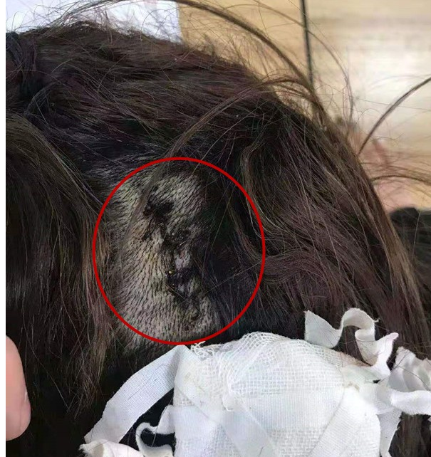 陕西大三女学生实习期间讨薪被打头部被缝数针如今警方介入调查