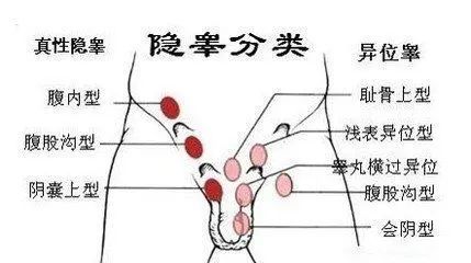 小儿隐睾症如何治疗?_腾讯新闻