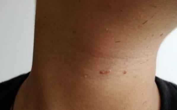 身上若长了"尖尖"的疙瘩,赶紧查hpv,提醒:早期2表现别忽视